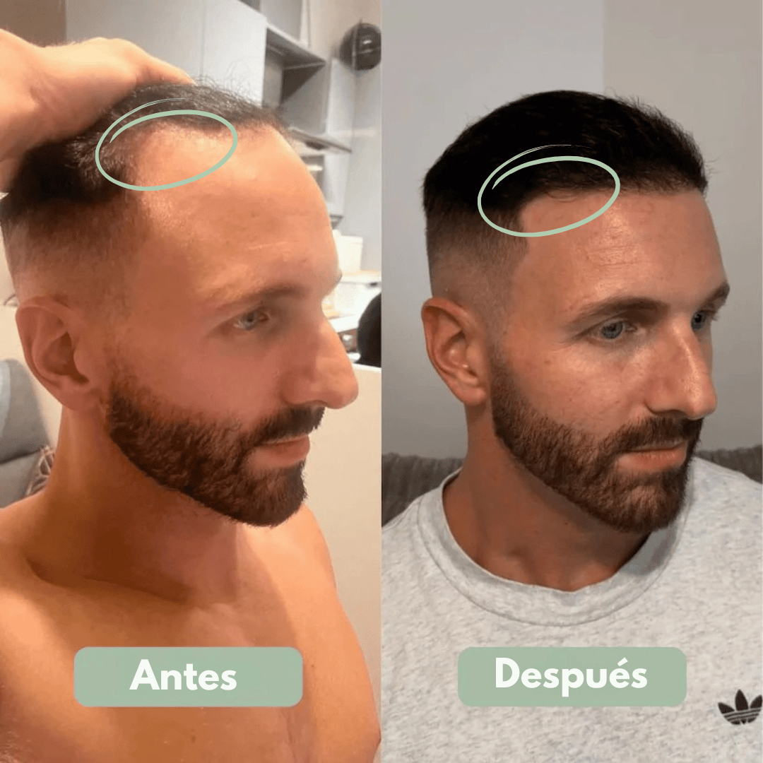 Reverse - Serum Roll-On para el Crecimiento Capilar