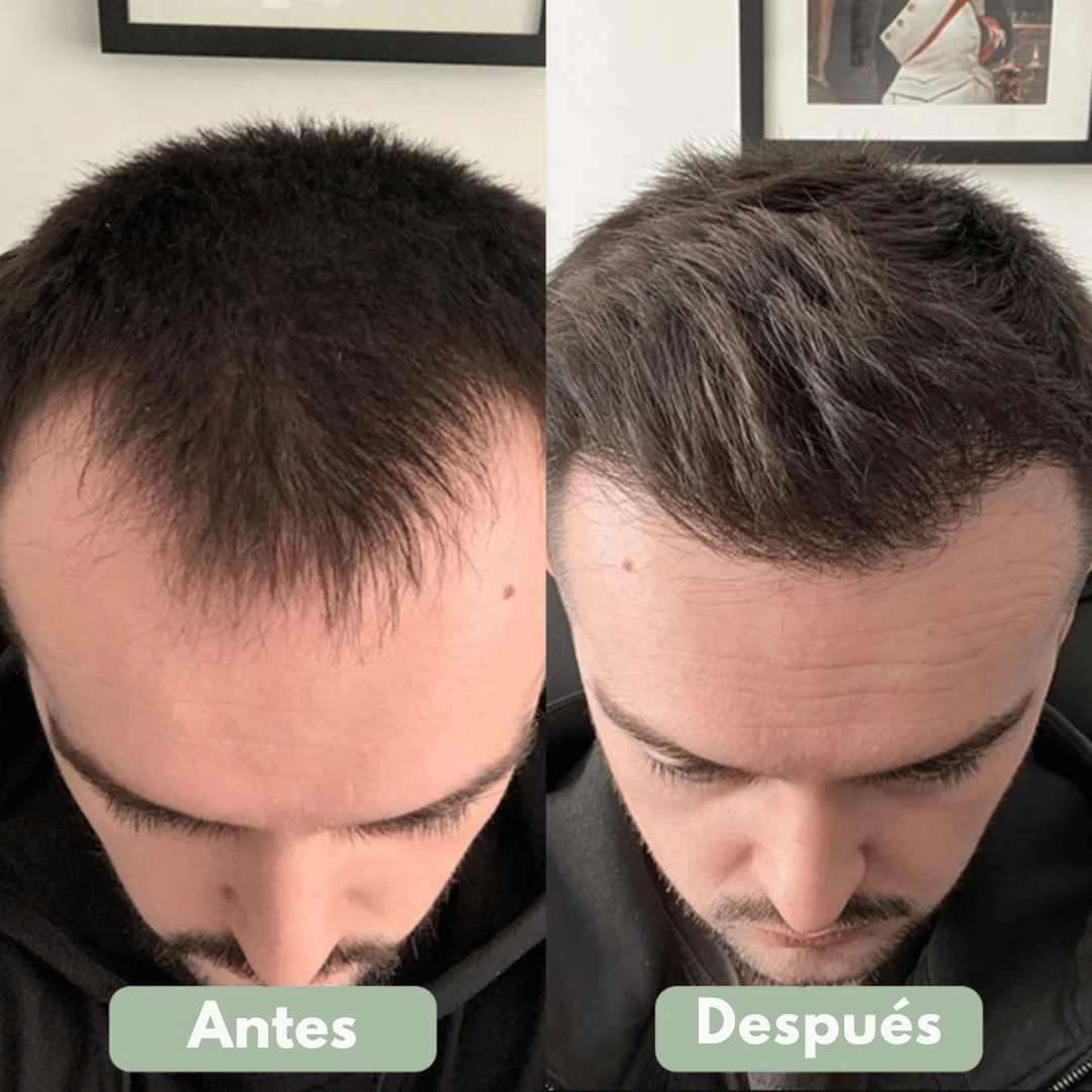 Reverse - Serum Roll-On para el Crecimiento Capilar